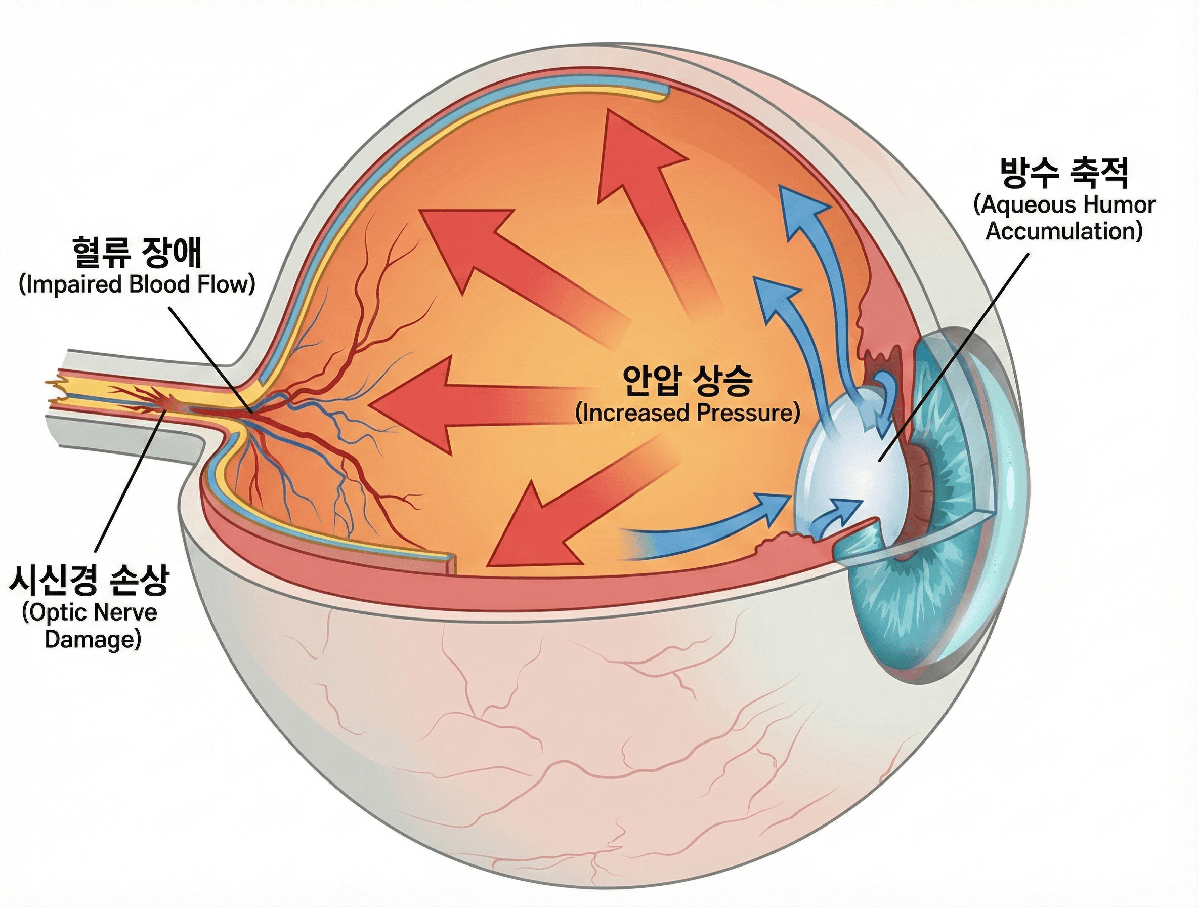 사가정역녹내장, 조기검진 대상 6가지 중 나도 포함될까요