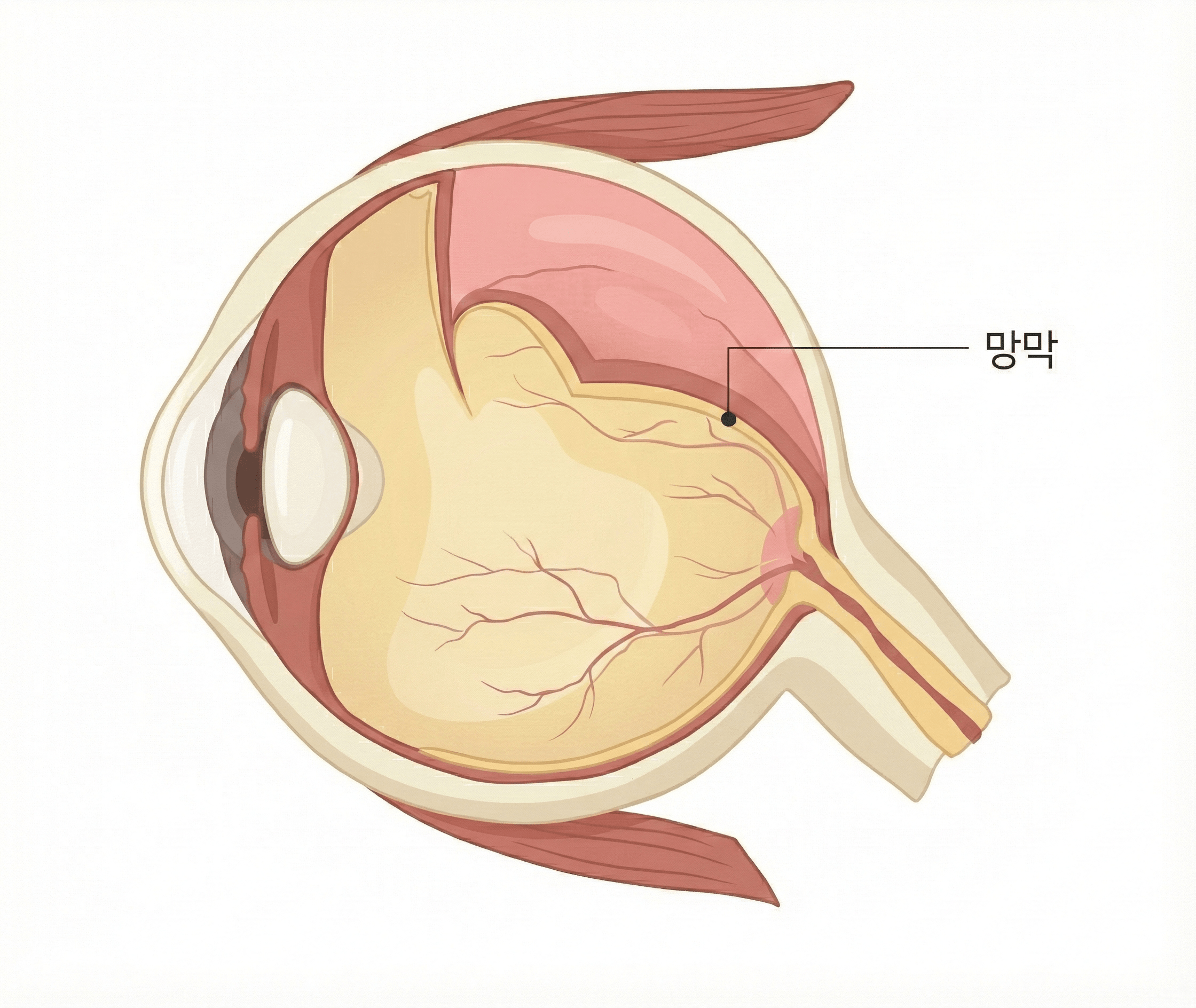 중랑구안과 망막박리, 커튼처럼 가려지는 시야를 놓치지 않으려면